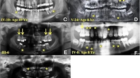 A fost descoperită cauza pentru o mutație genetică misterioasă