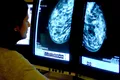 Zeci de mii de femei din Anglia ar putea primi un medicament pentru prevenirea cancerului de sân