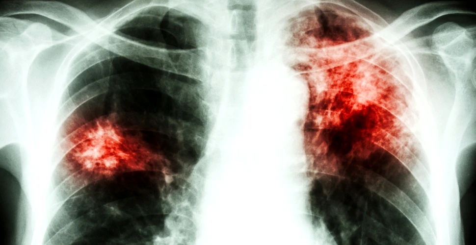 Tuberculoza, diagnosticată în doar două ore în Bucureşti şi Bisericani-Neamţ. Până acum dura 4-6 luni