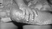 Vaccinare împotriva variolei în Marea Britanie, după cazurile de variola maimuţei