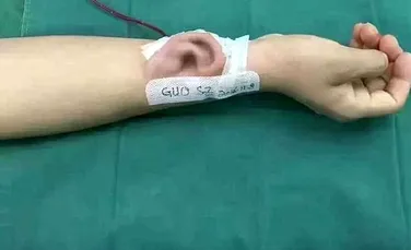Medicii au reuşit să crească pe mâna unui bărbat o ureche