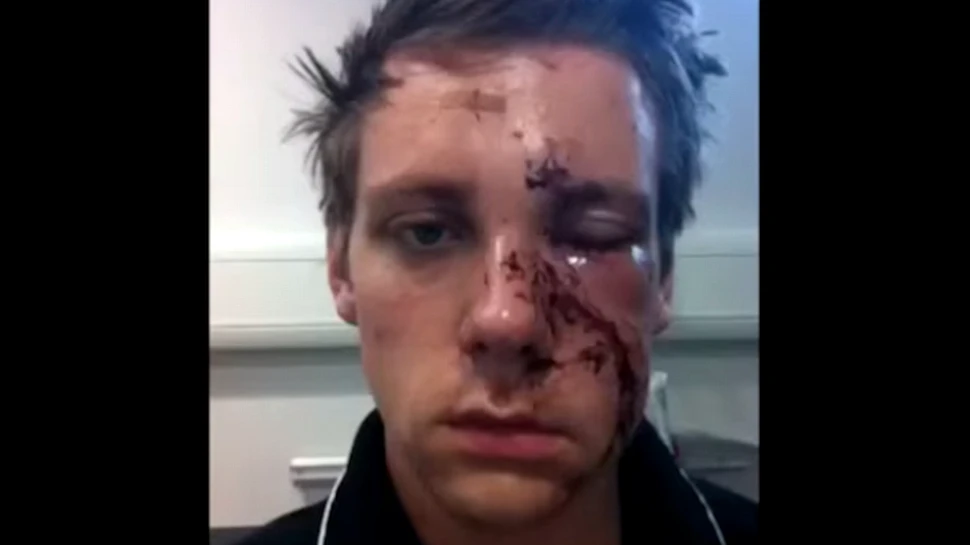 Un tânăr bătut pe stradă şi-a făcut zilnic selfie pentru a arăta transformarea chipului său. VIDEO time-lapse