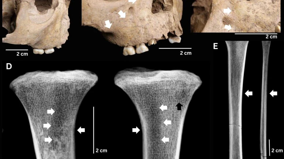Dinții copiilor antici dezvăluie o boală extrem de gravă de acum 4.000 de ani
