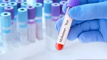 Un test simplu de sânge ar putea depista Alzheimer înainte de pierderea memoriei