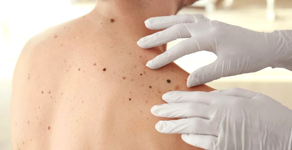 Niveluri mai ridicate de testosteron asociate cu un risc mai mare de melanom la bărbați