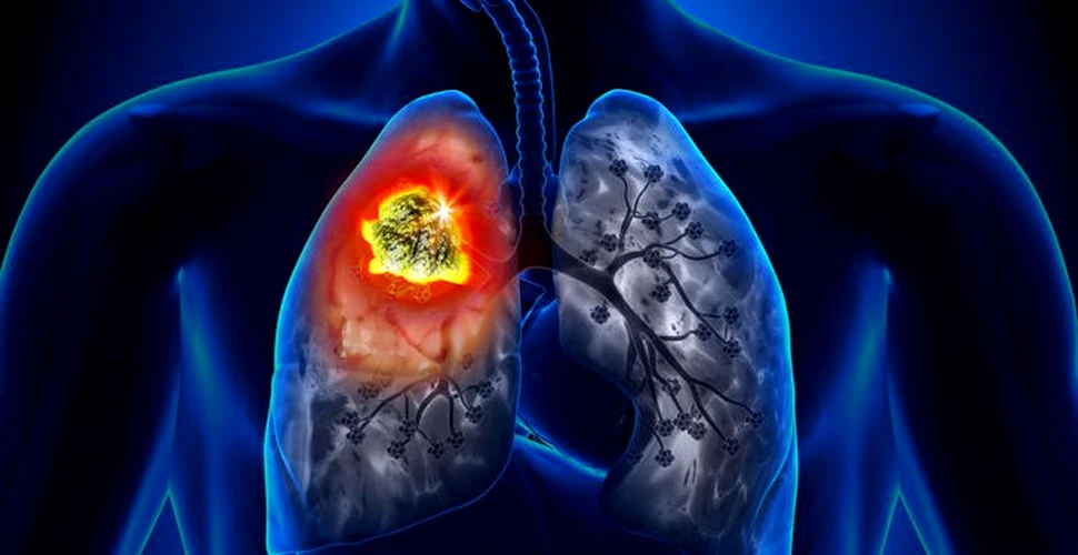 Un tip de vitamine utilizate frecvent poate creşte riscul apariţiei cancerului pulmonar