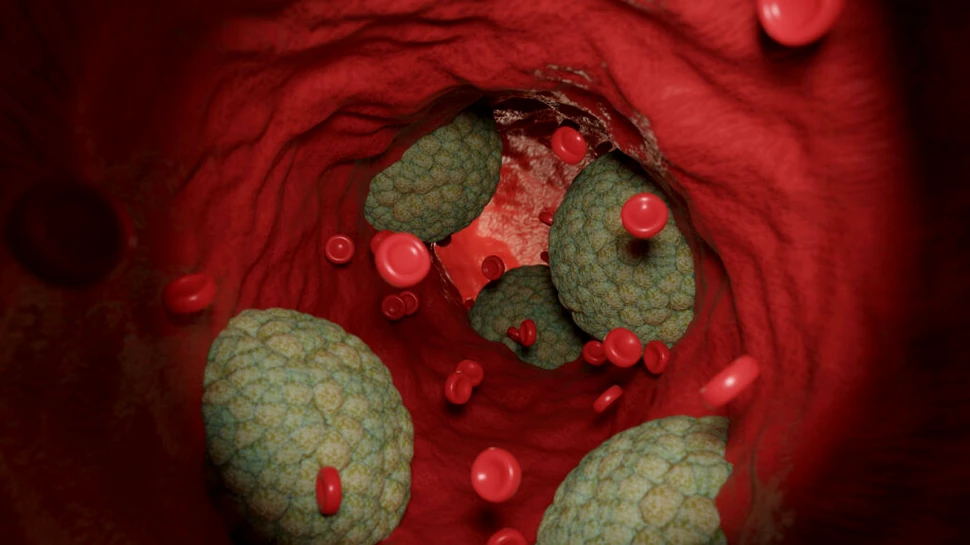 Ateroscleroza poate începe în tinerețe. Care sunt factorii de risc?