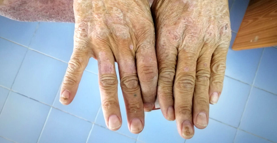 Primul transplant dublu de mâini pentru un pacient cu sclerodermie. Care este starea sa acum?