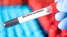 Scleroza multiplă poate începe mult mai devreme decât se credea anterior