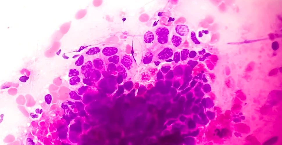 Infecția cu HPV, greșit înțeleasă atât de femei, cât și de bărbați. Mituri și realități