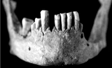 Un schelet vechi de patru milenii, prima evidenta a leprei