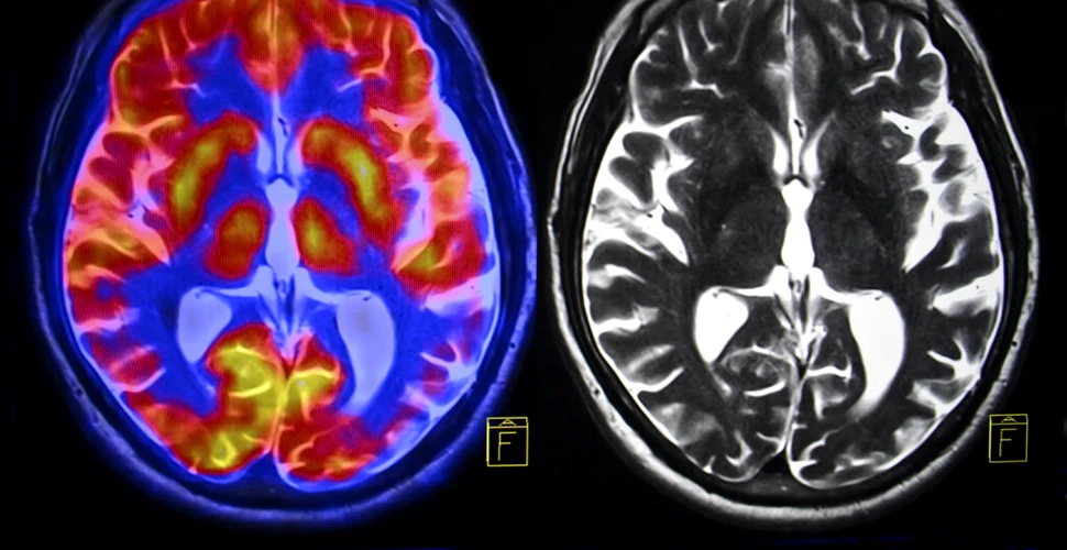 Bolile neurologice afectează mai mulți oameni decât s-a crezut până acum
