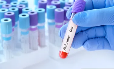 Un test simplu de sânge ar putea depista Alzheimer înainte de pierderea memoriei
