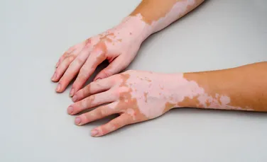 Un medicament pentru persoanele cu vitiligo a avut rezultate promițătoare într-un studiu clinic