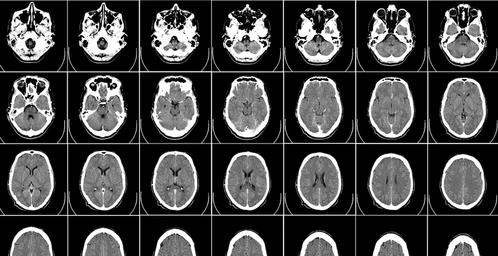 Un compus experimental oferă rezultate pozitive în cazul unor patologii ale Alzheimerului