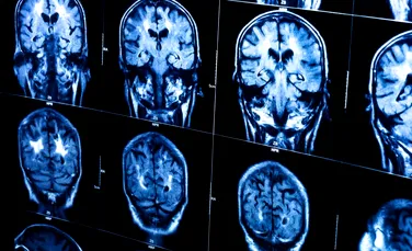 Oamenii de știință au introdus „o fereastră” în craniul unui bărbat pentru a-i citi creierul cu ultrasunete