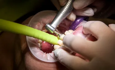 Caz bizar: dentiştii au extras mai mult de 500 de dinţi din gura unui băieţel din India