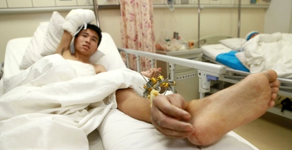 Operaţie incredibilă: medicii chinezi au ataşat braţul retezat al unui pacient la glezna acestuia (FOTO)