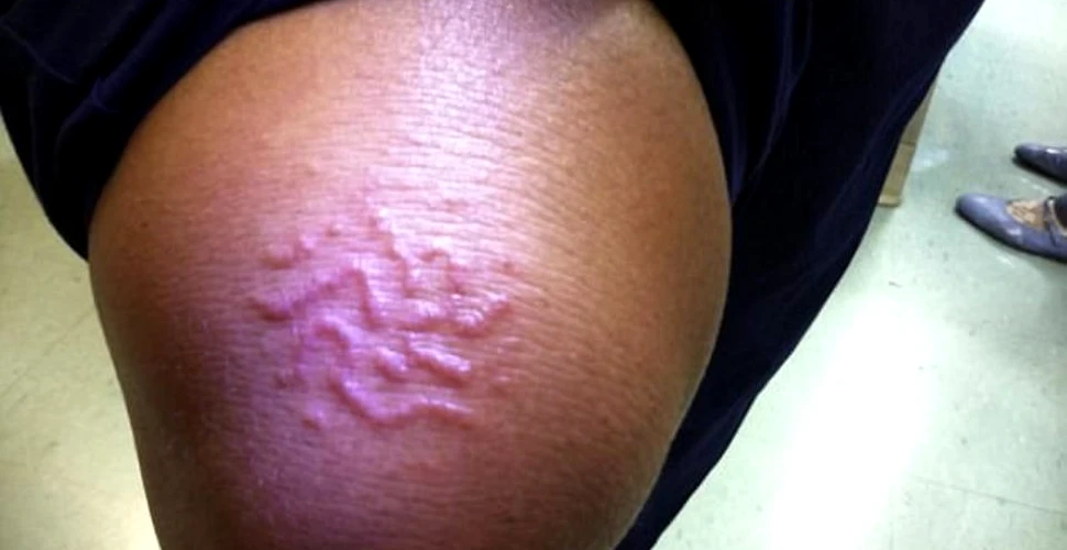 O femeie s-a ales cu o iritaţie la genunchi după o vacanţă în Caraibe. Lucrurile au luat o turnură îngrozitoare atunci când iritaţia a început să se mişte – FOTO
