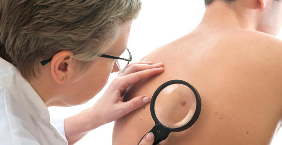 O pilulă revoluţionară contra cancerului de piele va fi testată în anii următori