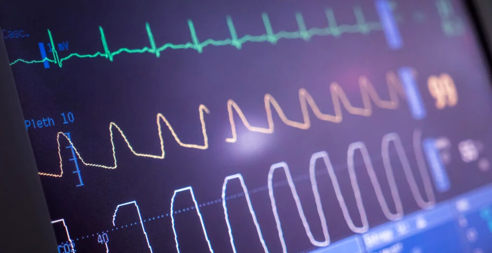 Electrocardiograma cu inteligență artificială ar putea identifica pacienții cu risc crescut de AVC