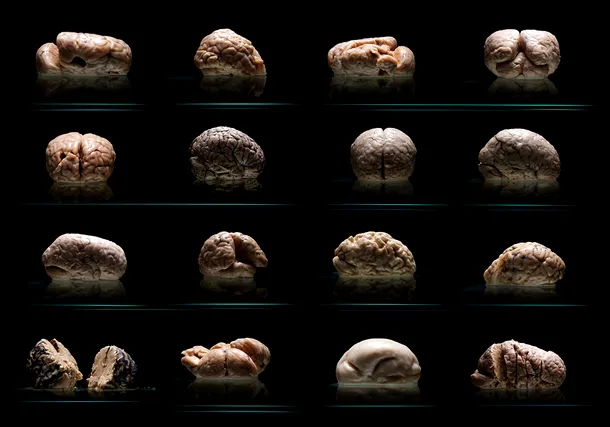 Creierele din colecţia universităţii prezintă diferite anomalii. Cazul de lisencefalie este al doilea exemplar din dreapta, pe rândul de jos