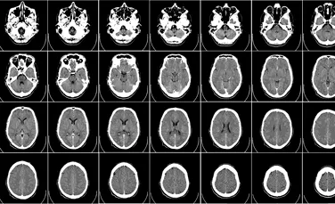 Un compus experimental oferă rezultate pozitive în cazul unor patologii ale Alzheimerului