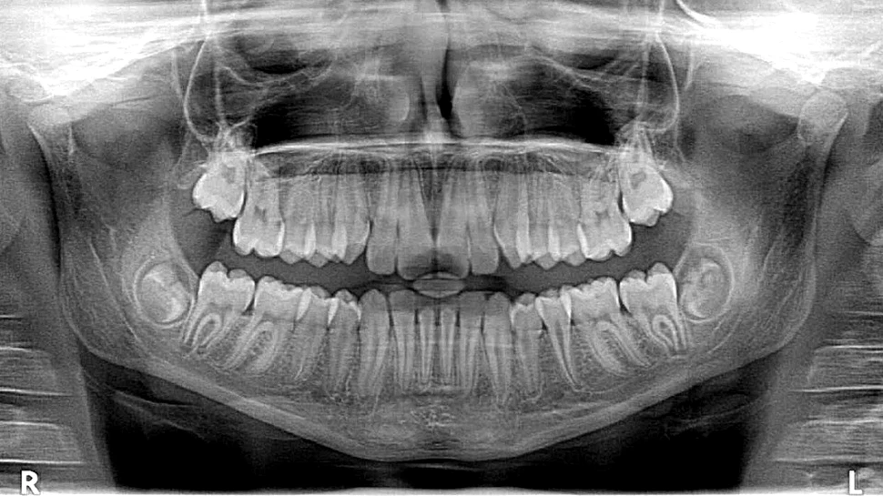 Un motiv să nu ne mai temem de dentist pe viitor: un nou tratament poate vindeca măselele fără să fie nevoie de plombe
