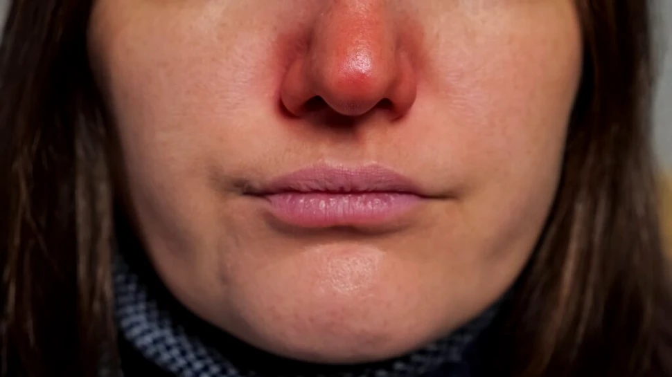 O răceală poate cauza simptome chiar și după patru săptămâni de la infecția inițială