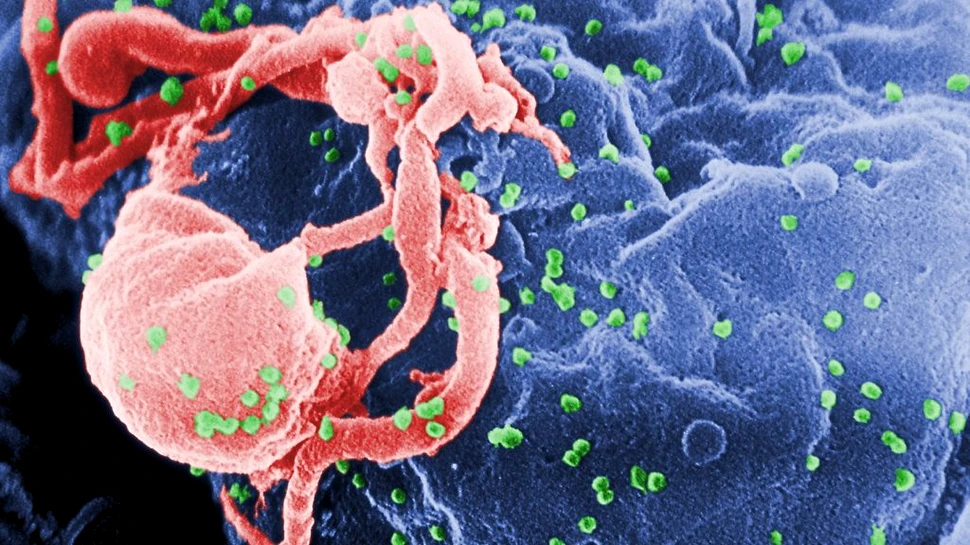 Cel mai vechi genom aproape complet al HIV a fost descoperit într-o mostră de țesut uitată din 1966