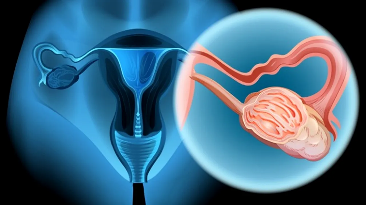 1-ovarian-cancer-1-696x554 