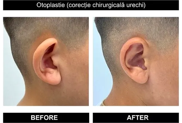 operația pentru urechi clăpăuge