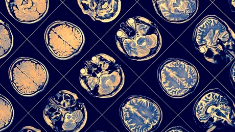 Grăsimea corporală ne-ar putea micșora creierul, arată un nou studiu