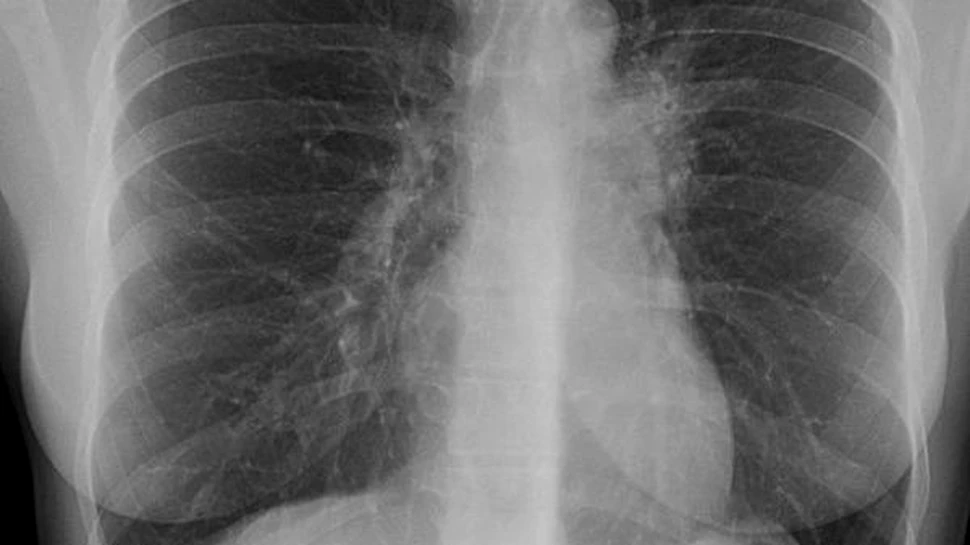 Tuberculoza loveste din nou