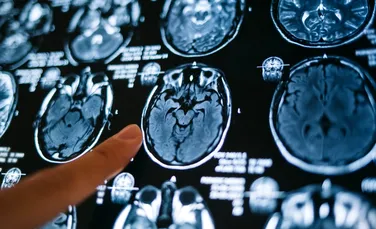 Oamenii de știință dezvăluie unde ar putea să își aibă originea schizofrenia în creier