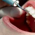 De ce este important detartrajul regulat pentru prevenirea afecțiunilor gingivale (P)