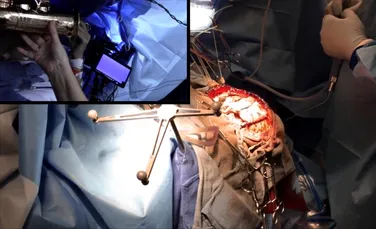 VIDEO. Intervenţie chirurgicală inedită: un muzician a fost operat pe creier în timp ce cânta la saxofon