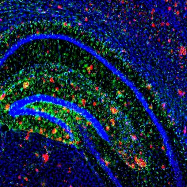 Plăci formate din beta-amiloide în creierul unui şoarece (cu roşu)