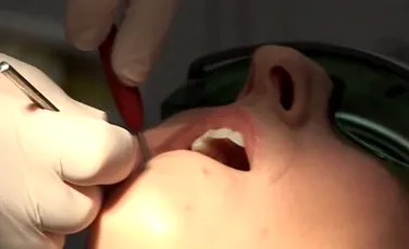 Reacţia incredibilă a unei femei când îi este scoasă o măsea, fiind „anesteziată” doar prin auto-hipnoză (VIDEO)