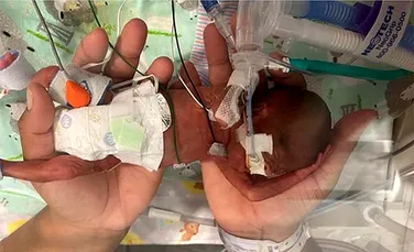 Un bebeluș născut prematur, cu o șansă de supraviețuire mai mică de 1%, a intrat în Cartea Recordurilor