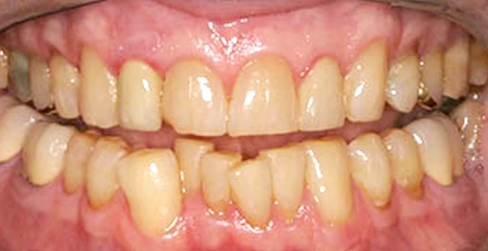 De ce mulţi oameni au dinţii înghesuiţi? Din cauza alimentaţiei, susţine un antropolog
