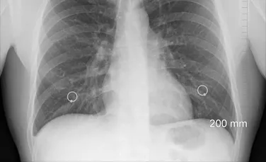 Cum modifică poluarea aerului țesutul pulmonar și favorizează apariția cancerului?