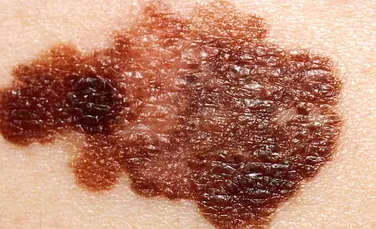 S-au descoperit două forme de melanom care nu sunt asociate cu cancerul de piele şi cu expunerea la soare