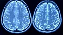 Depresia ar putea afecta capacitatea creierului de a genera noi neuroni
