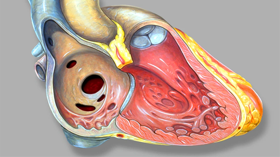 În fiecare zi, 40 de romani mor prin infarct miocardic