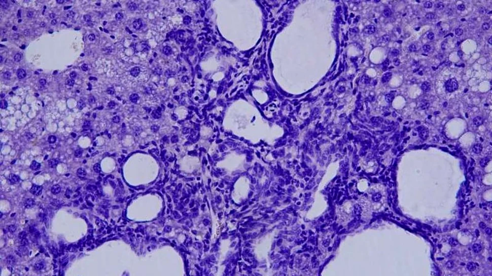 Cercetătorii au descoperit un nou mecanism care controlează evoluția cancerului hepatic