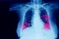 Medic de la Colentina: Infecția cu SARS-CoV-2 produce afecțiuni la nivelul tuturor organelor