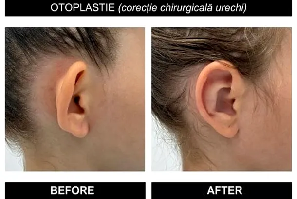 operația pentru urechi clăpăuge