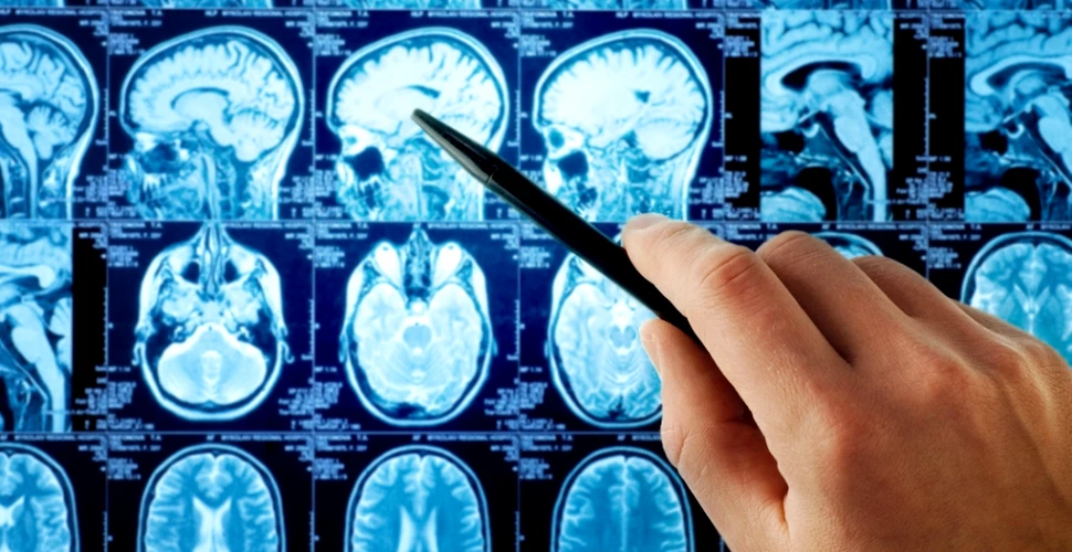 Anomalii cerebrale observate în creierul bolnavilor de sindromul oboselii cronice (FOTO)