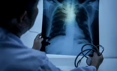 Cercetătorii au anunțat „o descoperire crucială” în cazul tuberculozei